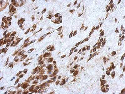 Immunohistochemistry-Paraffin: CCDC44 Antibody [NBP2-15749] - Immunohistochemical analysis of paraffin-embedded Hepatoma, using antibody at 1:500 dilution.