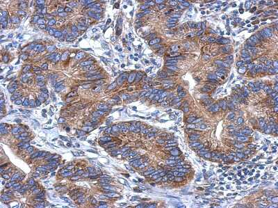 Immunohistochemistry-Paraffin: CCDC70 Antibody [NBP2-15754] - Immunohistochemical analysis of paraffin-embedded Colon ca, using antibody at 1:500 dilution.