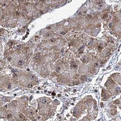 <b>Independent Antibodies Validation. </b>Immunohistochemistry-Paraffin: CCDC75 Antibody [NBP2-34044] - Staining of liver cancer.