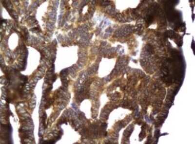 Immunohistochemistry: CCDC93 Antibody (OTI6E11) - Azide and BSA Free [NBP2-71963] - Analysis of Adenocarcinoma of Human endometrium tissue.