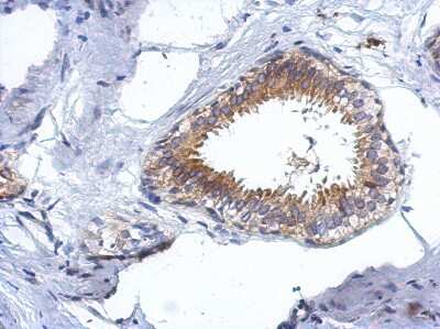 Immunohistochemistry-Paraffin: CCDC97 Antibody [NBP2-15758] - Immunohistochemical analysis of paraffin-embedded Breast ca, using antibody at 1:500 dilution.