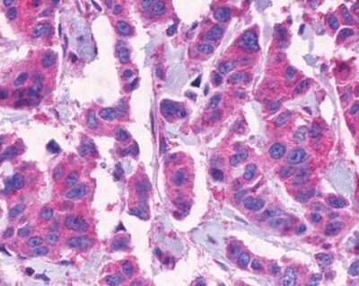 Immunohistochemistry-Paraffin: CCK-A R Antibody [NLS3293] - Analysis of anti-CCKAR / CCK1R antibody with human breast, carcinoma.