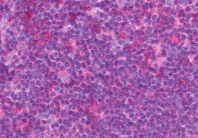 Immunohistochemistry-Paraffin: CCK-A R Antibody [NLS3293] - Anti-CCKAR / CCK1R antibody IHC of human Lymph Node, Non-Hodgkins Lymphoma. Immunohistochemistry of formalin-fixed, paraffin-embedded tissue after heat-induced antigen retrieval.