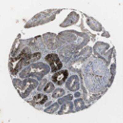 Immunohistochemistry: CCL2/MCP1 Antibody [20530002] - Strong cytoplasmic positivity with additional staining of luminal membranes was seen in mucus-producing cells of the gastro-intestinal tract. Cells of the CNS and lymphoid tissues were in general negative, except for mast cells, which were strongly positive. In malignant tissues, mucin secreting colo-rectal carcinomas and mucinous cystadenocarcinomas of ovary exhibited strong cytoplasmic staining with additional positivity of luminal membranes. Few other adenocarcinomas were strongly stained in cytoplasm. Malignant gliomas, lymphomas and renal cancers were mainly negative.  Image and statement courtesy of the Human Protein Atlas (HPA).