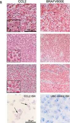 Immunohistochemistry-Paraffin: CCL2/MCP1 Antibody [20530002] - CCL2 is expressed by melanoma cells in tumor tissues from patients. CCL2 immunostaining of three representative tumor lesions showing low (upper), moderate (middle), or high (lower) staining intensity; these lesions were all stained positive for BRAFV600E. At the bottom, ISH showing the CCL2-specific signal in the tumor cells (black arrows); UBC staining was used as a control. Image collected and cropped by CiteAb from the following publication (//www.oncotarget.com/fulltext/6599) licensed under a CC-BY license.