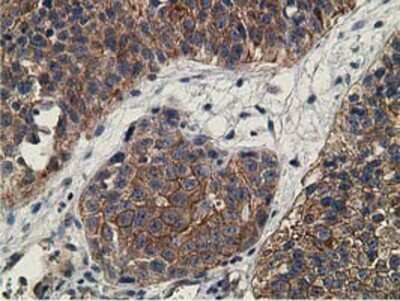 Immunohistochemistry-Paraffin: CCNB1IP1 Antibody (4H3) [NBP2-00600] - Staining of paraffin-embedded Carcinoma of Human bladder tissue using anti-CCNB1IP1 mouse monoclonal antibody.