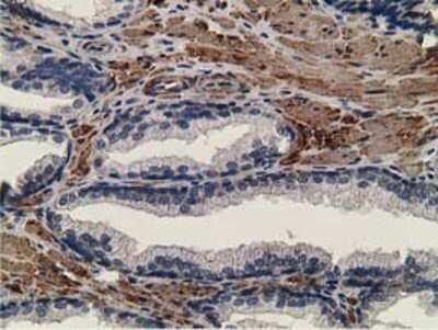 Immunohistochemistry-Paraffin: CCNB1IP1 Antibody (4H3) [NBP2-00600] - Staining of paraffin-embedded Carcinoma of Human prostate tissue using anti-CCNB1IP1 mouse monoclonal antibody.