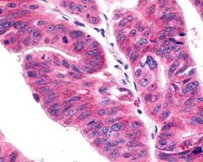 Immunohistochemistry-Paraffin: CCR11 Antibody [NLS1441] - Analysis of anti-ACKR4 / CCRL1 / CCR11 antibody with human colon, carcinoma.