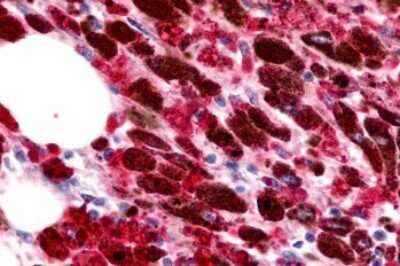 Immunohistochemistry-Paraffin: CCR11 Antibody [NLS1441] - Anti-ACKR4 / CCRL1 / CCR11 antibody IHC of human Skin, Melanoma. Immunohistochemistry of formalin-fixed, paraffin-embedded tissue after heat-induced antigen retrieval.