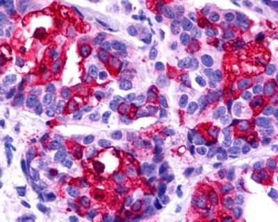 Immunohistochemistry-Paraffin: CCR11 Antibody [NLS1442] - Analysis of anti-ACKR4 / CCRL1 / CCR11 antibody with human breast, carcinoma.