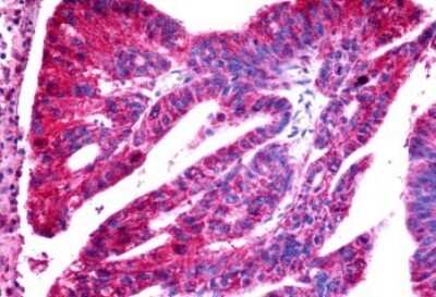 Immunohistochemistry-Paraffin: CCR11 Antibody [NLS1442] - Anti-ACKR4 / CCRL1 / CCR11 antibody IHC of human Colon, Carcinoma. Immunohistochemistry of formalin-fixed, paraffin-embedded tissue after heat-induced antigen retrieval.