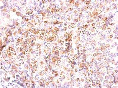 Immunohistochemistry-Paraffin: CCR8 Antibody [NBP2-15768] - A549 xenograft. CCR8 antibody dilution: 1:500. Antigen Retrieval: Trilogy™ (EDTA based, pH 8.0) buffer, 15min. 