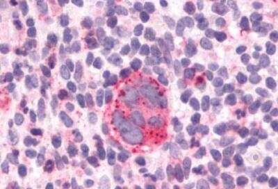 Immunohistochemistry-Paraffin: CCR9 Antibody [NLS961] - Lymph node, Hodgkin's Disease