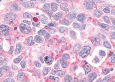 Immunohistochemistry-Paraffin: CCR9 Antibody [NLS961] - Breast, adenocarcinoma