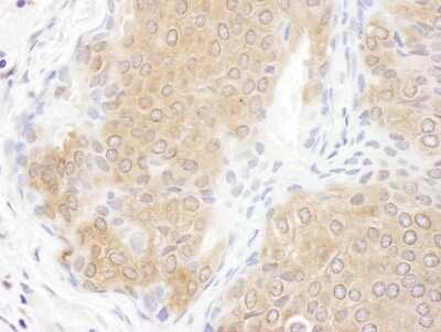 Immunohistochemistry-Paraffin: CCT3 Antibody [NBP1-79040] - Section of human lung carcinoma. Antibody: Affinity purified rabbit anti- CCT3 used at a dilution of 1:200 (1ug/ml). Detection: DAB. Counterstain: hematoxylin (blue).