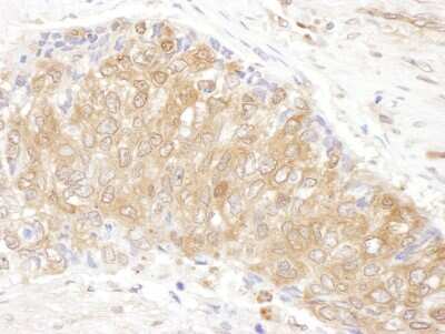 Immunohistochemistry-Paraffin: CCT3 Antibody [NBP1-79041] - Sample: FFPE section of human lung carcinoma. Antibody: Affinity purified rabbit anti- CCT3 used at a dilution of 1:200 (1ug/ml). Detection: DAB. Counterstain: hematoxylin (blue).