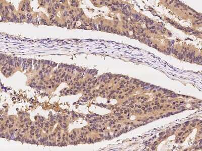 Immunohistochemistry-Paraffin: CCT3 Antibody [NBP2-99267] - Immunochemical staining of human CCT3 in human colon carcinoma with rabbit polyclonal antibody at 1:300 dilution, formalin-fixed paraffin embedded sections.