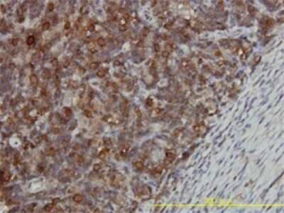 Immunohistochemistry-Paraffin: CCT5 Antibody (4E5-4B1) [H00022948-M01] - Analysis of monoclonal antibody to CCT5 on formalin-fixed paraffin-embedded human lymphoma tissue. Antibody concentration 1 ug/ml.