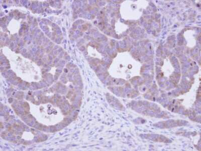 Immunohistochemistry-Paraffin: CCT5 Antibody [NBP1-31337] - Paraffin-embedded NCIN87 xenograft, using antibody at 1:500 dilution.