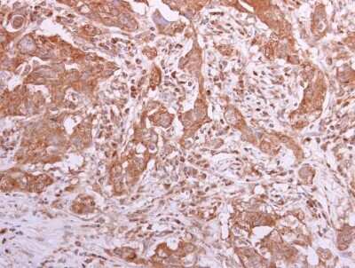 Immunohistochemistry-Paraffin: CCT8 Antibody [NBP1-33486] - TCP1 theta antibody detects TCP1 theta protein at cytoplasm in human breast carcinoma by immunohistochemical analysis. Sample: Paraffin-embedded human breast carcinoma. TCP1 theta antibody diluted at 1:500.