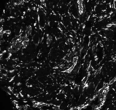 Immunohistochemistry-Paraffin: CD117/c-kit Antibody (C117/370 + KIT/982 + KIT/983) - Azide and BSA Free [NBP2-47845] - Human skin angiosarcoma (FFPE tissue) stained with c-kit. pH 9 HIER antigen retrieval. Image from verified customer review.