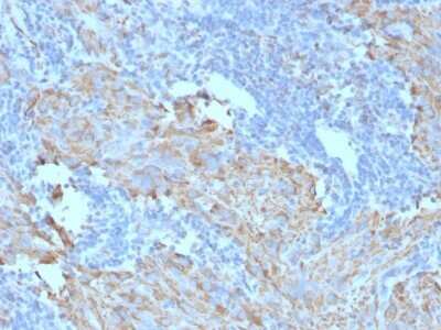Immunohistochemistry-Paraffin: CD117/c-kit Antibody (C117/370) - Azide and BSA Free [NBP2-33192] - Formalin-fixed, paraffin-embedded human GIST stained with CD117/c-kit Antibody (C117/370).