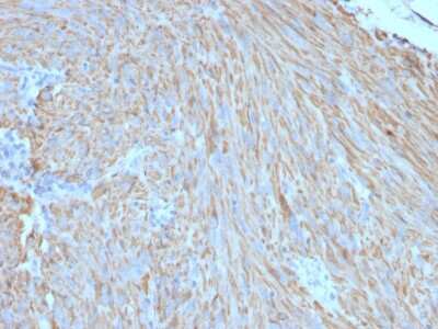 Immunohistochemistry-Paraffin: CD117/c-kit Antibody (C117/370) - Azide and BSA Free [NBP2-33192] - Formalin-fixed, paraffin-embedded human GIST stained with CD117/c-kit Mouse Monoclonal Antibody (C117/370).