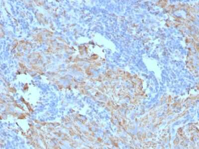 Immunohistochemistry-Paraffin: CD117/c-kit Antibody (C117/370) [NBP2-29423] - Formalin-fixed, paraffin-embedded human GIST stained with CD117/c-kit Antibody (C117/370).