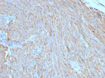 Immunohistochemistry-Paraffin: CD117/c-kit Antibody (C117/370) [NBP2-29423] - Formalin-fixed, paraffin-embedded human GIST stained with CD117/c-kit Mouse Monoclonal Antibody (C117/370).