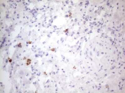 Immunohistochemistry: CD117/c-kit Antibody (OTI2B12) - Azide and BSA Free [NBP2-71076] - Analysis of Carcinoma of Human bladder tissue.(Heat-induced epitope retrieval by 1mM EDTA in 10mM Tris buffer (pH8.5) at 120C for 3 min)