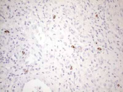 Immunohistochemistry: CD117/c-kit Antibody (OTI2B12) - Azide and BSA Free [NBP2-71076] - Analysis of Carcinoma of Human liver tissue.(Heat-induced epitope retrieval by 1mM EDTA in 10mM Tris buffer (pH8.5) at 120C for 3 min)