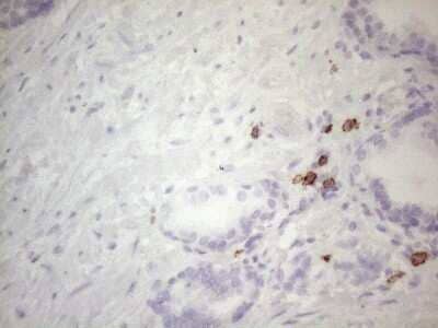 Immunohistochemistry: CD117/c-kit Antibody (OTI2B12) - Azide and BSA Free [NBP2-71076] - Analysis of Carcinoma of Human prostate tissue. (Heat-induced epitope retrieval by 1mM EDTA in 10mM Tris buffer (pH8.5) at 120C for 3 min)