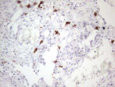 Immunohistochemistry-Paraffin: CD117/c-kit Antibody (OTI2B12) - Azide and BSA Free [NBP2-71076] - Staining of Adenocarcinoma of Human colon tissue using anti-KIT mouse monoclonal antibody. (Heat-induced epitope retrieval by 1mM EDTA in 10mM Tris buffer (pH8.5) at 120 degrees C for 3min.