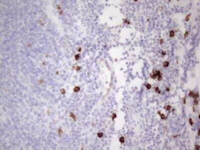 Immunohistochemistry-Paraffin: CD117/c-kit Antibody (OTI2B12) - Azide and BSA Free [NBP2-71076] - Staining of Carcinoma of Human thyroid tissue using anti-KIT mouse monoclonal antibody. (Heat-induced epitope retrieval by 1mM EDTA in 10mM Tris buffer (pH8.5) at 120 degrees C for 3min.