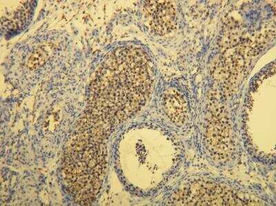 Immunohistochemistry-Paraffin: CD117/c-kit Antibody (R21-V) [NBP1-79010] - Membranous CD117 positivity in the classical seminoma. Formalin fixed, paraffin embedded human tissues (4 um sections) stained with anti - CD117.