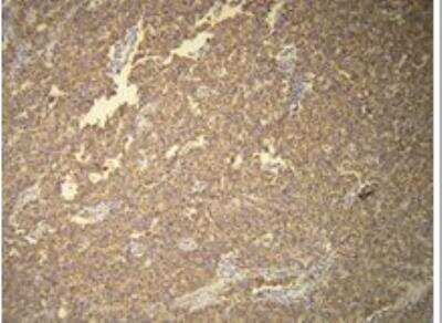 Immunohistochemistry-Paraffin: CD117/c-kit Antibody (R21-V) [NBP1-79010] - Membranous CD117 positivity in the classical seminoma. Formalin fixed, paraffin embedded human tissues (4 um sections) stained with anti-CD117 monospecific clonal antibody.