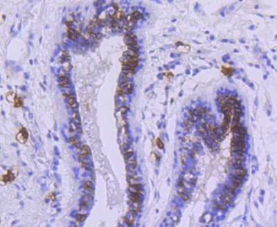 Immunohistochemistry-Paraffin: CD117/c-kit Antibody (ST04-99) [NBP2-67531] - Analysis of paraffin-embedded human breast carcinoma tissue using anti-c-Kit antibody. Counter stained with hematoxylin.