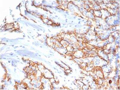 Immunohistochemistry-Paraffin: CD133 Antibody (PROM/6316) - Azide and BSA Free [NBP3-08969] - Formalin-fixed, paraffin-embedded human papillary renal cell carcinoma stained with CD133 antibody (PROM/6316) - Azide and BSA Free.