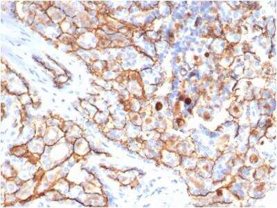 Immunohistochemistry-Paraffin: CD133 Antibody (PROM/6316) - Azide and BSA Free [NBP3-08969] - Formalin-fixed, paraffin-embedded human papillary renal cell carcinoma stained with CD133 antibody (PROM/6316) - Azide and BSA Free.
