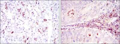 Immunohistochemistry: CD1a Antibody (7A7) [NBP2-37622] - Immunohistochemical analysis of paraffin-embedded cervical cancer tissues (left) and colon cancer tissues (right) using CD1A mouse mAb with DAB staining.