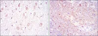 Immunohistochemistry: CD1a Antibody (7A7) [NBP2-37622] - Immunohistochemical analysis of paraffin-embedded brain tissues (left) and submaxillary tumor tissues (right) using CD1A mouse mAb with DAB staining.