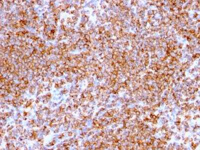 Immunohistochemistry-Paraffin: CD20 Antibody (IGEL/773) - IHC-Prediluted [NBP2-48335] - Formalin-fixed, paraffin-embedded human Lymphoma