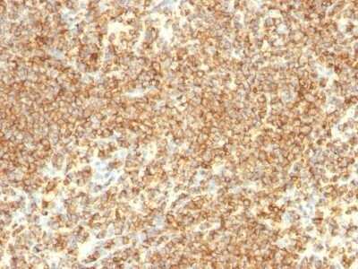 Immunohistochemistry-Paraffin: CD20 Antibody (IGEL/773) - IHC-Prediluted [NBP2-48335] - Human Lymphoma stained with CD20 Monoclonal Antibody (IGEL/773)