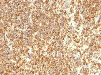 Immunohistochemistry-Paraffin: CD20 Antibody (SPM494) - IHC-Prediluted [NBP2-48308] - Formalin-fixed, paraffin-embedded human Lymphoma stained with CD20 Monoclonal Antibody (SPM494)