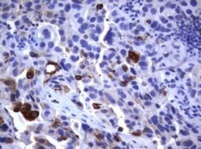 Immunohistochemistry: CD23/Fc epsilon RII Antibody (OTI2B6) - Azide and BSA Free [NBP2-70701] - Analysis of Carcinoma of Human bladder tissue. (Heat-induced epitope retrieval by 10mM citric buffer, pH6.0, 120C for 3min)