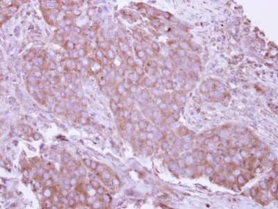 Immunohistochemistry-Paraffin: CD27 Antibody [NBP2-15790] - Immunohistochemical analysis of paraffin-embedded Breast ca, using antibody at 1:250 dilution.