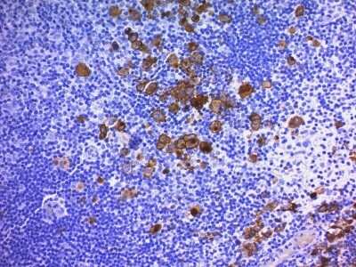 Immunohistochemistry-Paraffin: CD30/TNFRSF8 Antibody (Ber-H2 + CD30/412) [NBP2-44563] - Human Hodgkin's Lymphoma stained with CD30 Monoclonal Antibody (Ber-H2 + CD30/412).