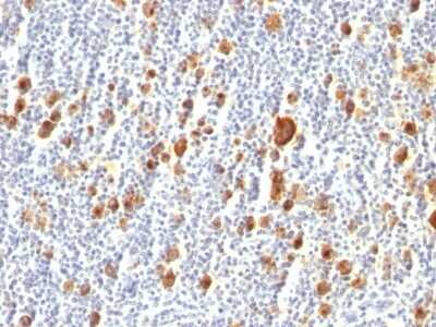 Immunohistochemistry-Paraffin: CD30/TNFRSF8 Antibody (Ber-H2) [NBP2-44559] - Human Hodgkin's Lymphoma stained with CD30 Monoclonal Antibody (Ber-H2).