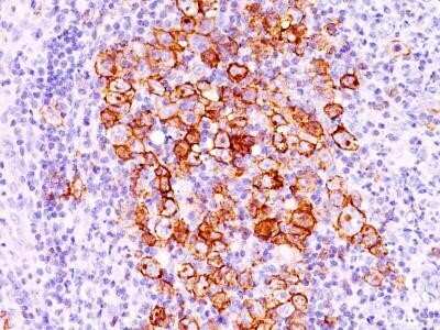 Immunohistochemistry-Paraffin: CD30/TNFRSF8 Antibody (CD30/412) - IHC-Prediluted [NBP2-44558] - Formalin-fixed, paraffin-embedded Hodgkin's lymphoma (20X) stained with CD30 Ab (CD30/412).
