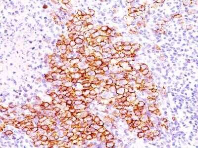 Immunohistochemistry-Paraffin: CD30/TNFRSF8 Antibody (CD30/412) - IHC-Prediluted [NBP2-44558] - Formalin-fixed, paraffin-embedded Hodgkin's lymphoma(20X) stained with CD30 Ab (CD30/412).